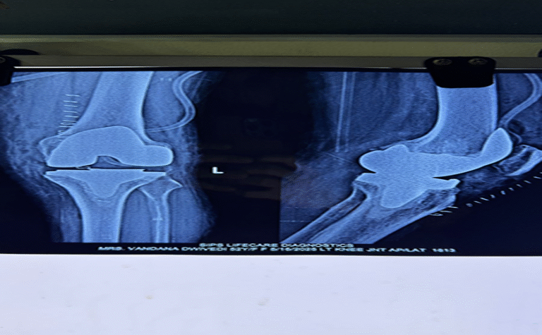 joint replacement surgery